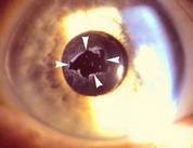 Лазерное удаление вторичной катаракты на ашмарина в чебоксарах