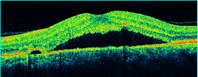 Окт сетчатки глаза диагностические центры в туле