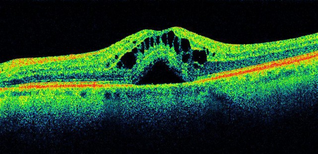 Окт сетчатки глаза диагностические центры в туле