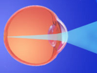 Операция на глаза в 56 лет дальнозоркость ижевск