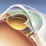 Вторичная катаракта лечение лазером цена в клинике гельмгольца