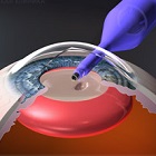 Глазная клиника семашко рязань цены на операцию катаракта