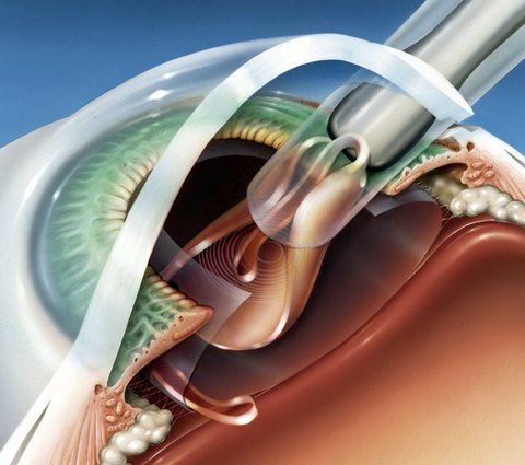 Коновалов офтальмолог лечение катаракты