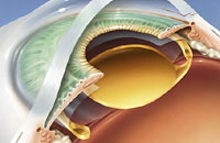 Лазерная операция катаракты ташкенте