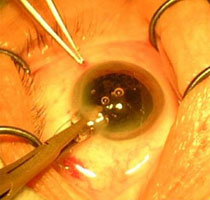 Сколько стоит в волгограде операция катаракта глаз
