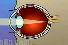 Адреса клиник по лазерному удалению катаракты в рязани