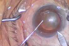 Адреса клиник по лазерному удалению катаракты в рязани