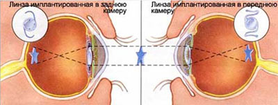 Глазная поликлиника курск садовая операция катаракты