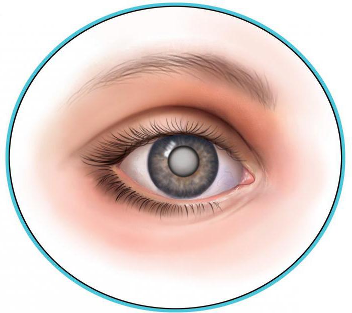 Глазные болезни на россолимо катаракта операции