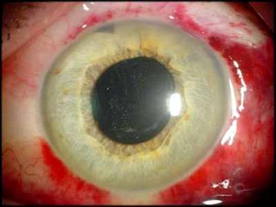 Операции на глаза катаракта в александрове