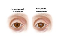 Операции на глаза катаракта в александрове