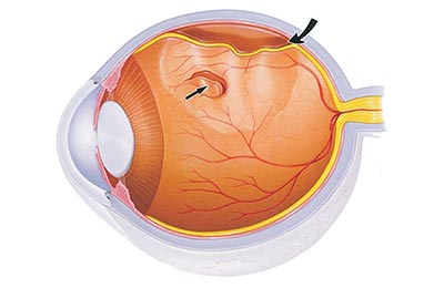 Операция на глаз в александрове