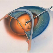 Подольск глазные операции
