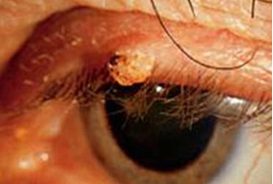 Удаление папилломы глаз клиника гельмгольца