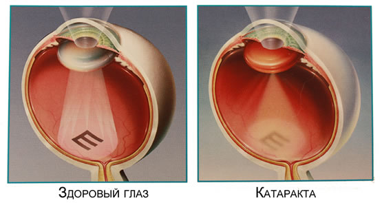 Лечение катаракты в частных клиниках г калининград