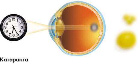 Лечение катаракты в частных клиниках г калининград