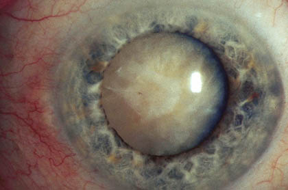 Лечение катаракты в клинике мулдашева