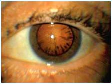 Лечение катаракты в клинике мулдашева