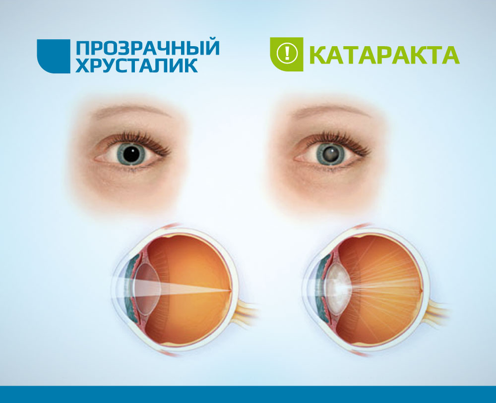 В какой клинике г омска проводят операции катаракты любой сложности